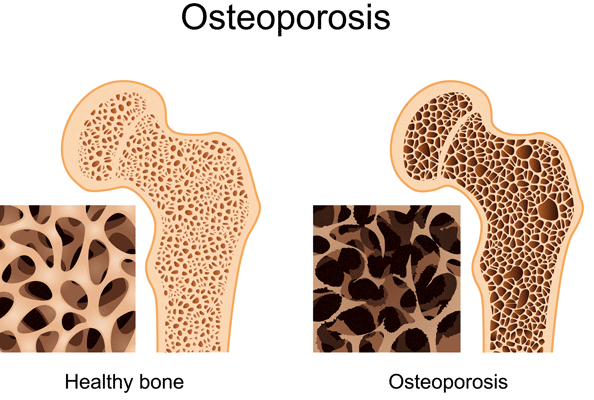 Osteoporose Test